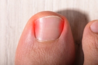 Possible Symptoms of an Ingrown Toenail