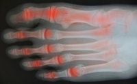Can Arthritis in the Feet Be Helped?
