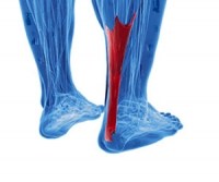 A Complete or Partial Achilles Tendon Tear