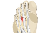 Surgery for Morton’s Neuroma