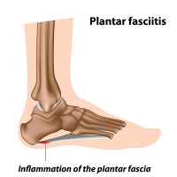 How Podiatrists Diagnose and Heal Plantar Fasciitis