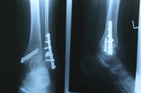 Did I Break My Ankle?
