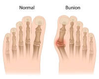 Why Do Bunions Develop?