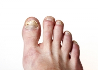 Causes and Treatment of Toenail Fungus