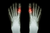 Gout and Ways to Manage It